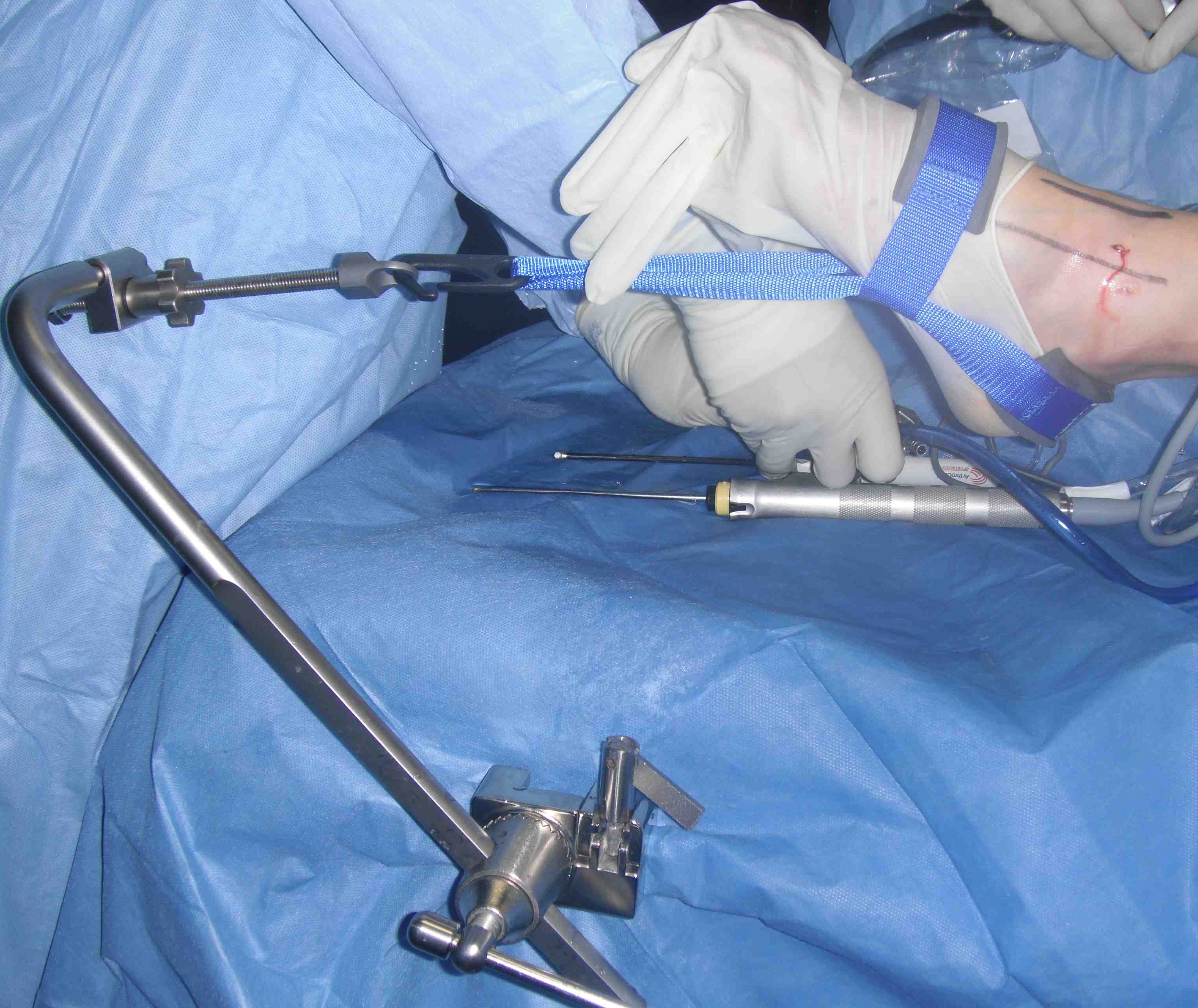 Ankle Arthroscopy Traction